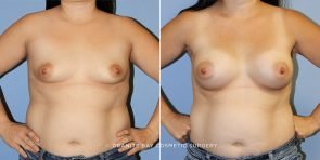 breast-augmentation-9291a-clark