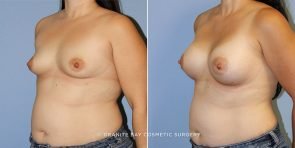 breast-augmentation-9291b-clark