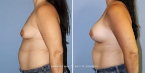 breast-augmentation-9291c-clark