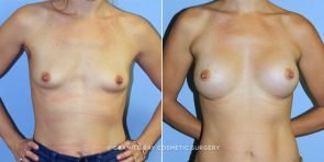 breast-augmentation-9298a-clark