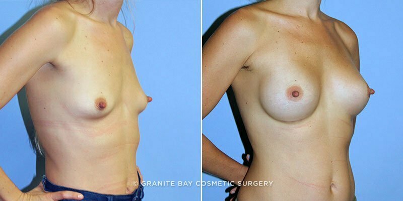 breast-augmentation-9298b-clark