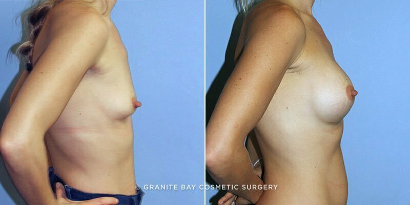 breast-augmentation-9298c-clark