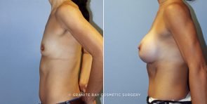 breast-augmentation-9319c-clark