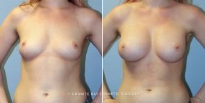 breast-augmentation-9326a-clark
