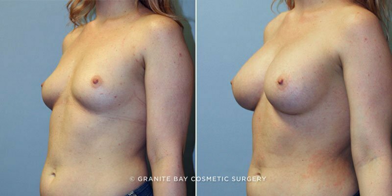 breast-augmentation-9326b-clark
