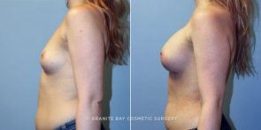 breast-augmentation-9326c-clark