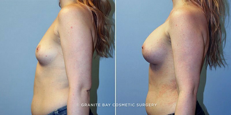 breast-augmentation-9326c-clark