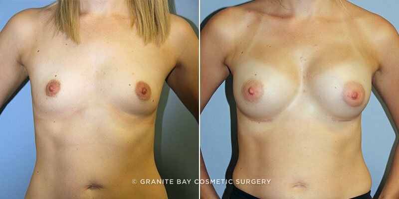 breast-augmentation-9346a-clark