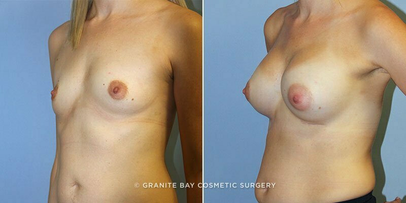 breast-augmentation-9346b-clark
