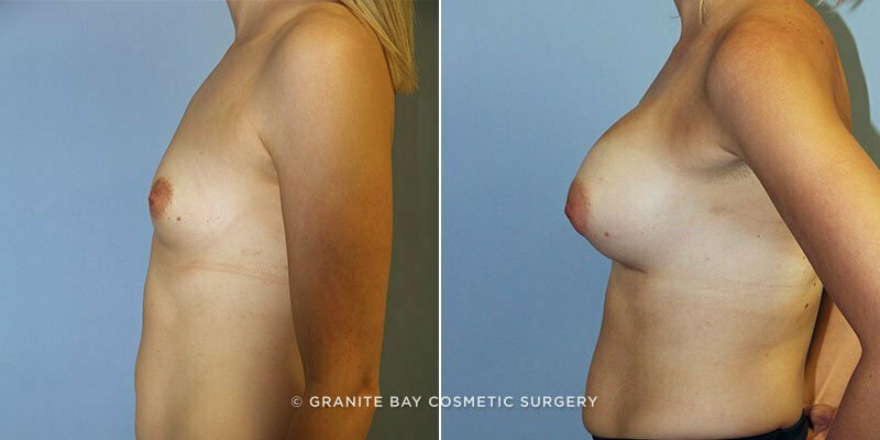 breast-augmentation-9346c-clark