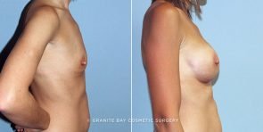 breast-augmentation-9378c-clark