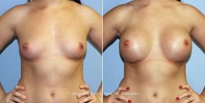 breast-augmentation-9403a-clark
