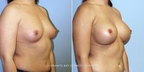 breast-augmentation-9403b-clark