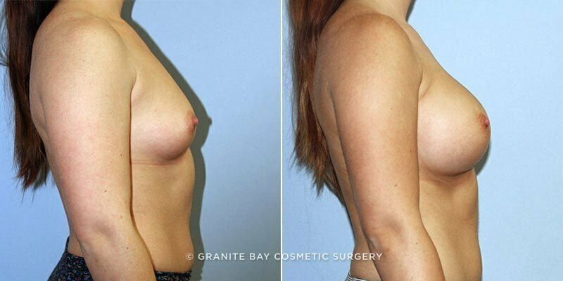 breast-augmentation-9403c-clark