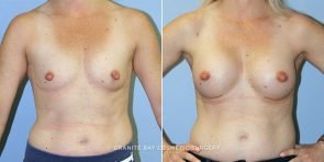breast-augmentation-9447a-clark