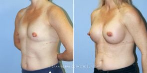 breast-augmentation-9447b-clark
