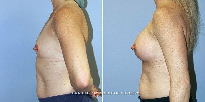 breast-augmentation-9447c-clark