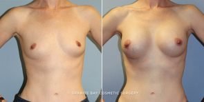 breast-augmentation-9460a-clark