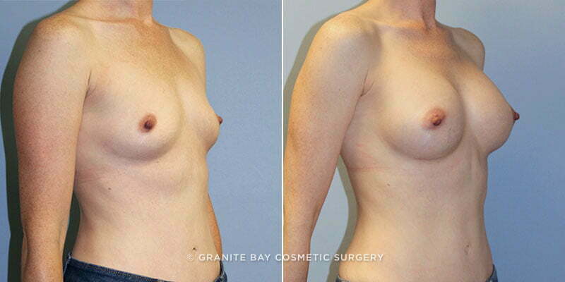 breast-augmentation-9460b-clark