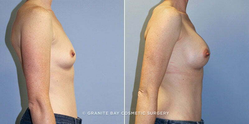 breast-augmentation-9460c-clark