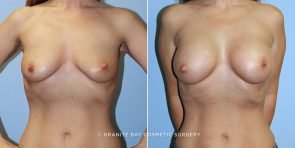 breast-augmentation-9500a-clark