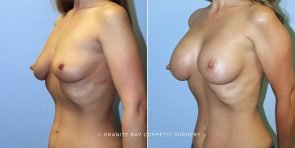 breast-augmentation-9500b-clark