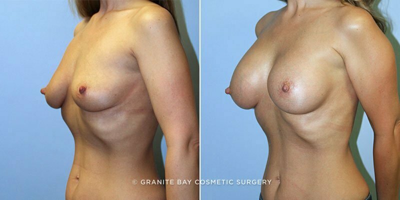 breast-augmentation-9500b-clark