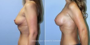 breast-augmentation-9500c-clark