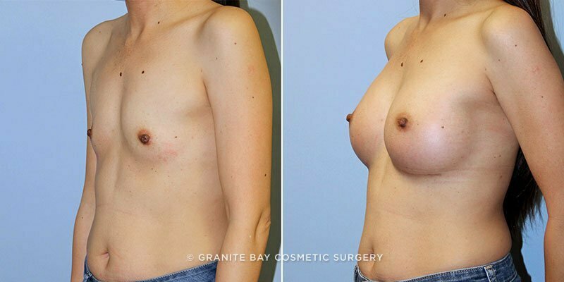 breast-augmentation-9507b-clark