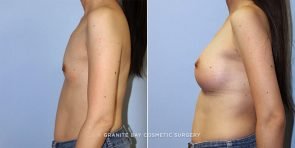 breast-augmentation-9507c-clark