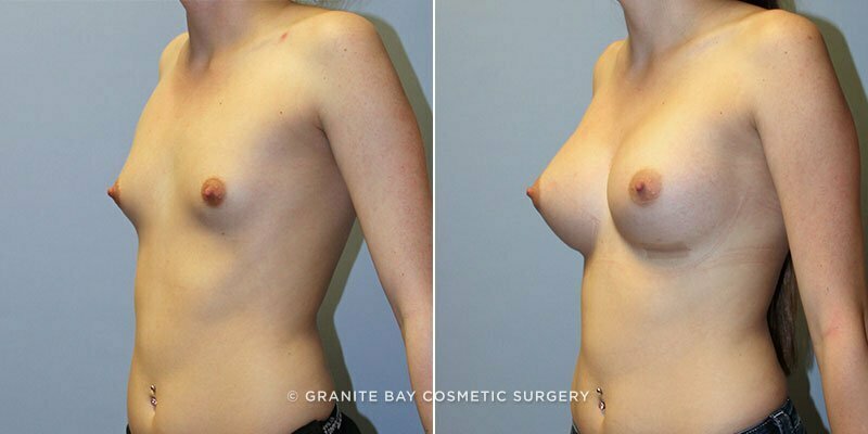 breast-augmentation-9652b-clark