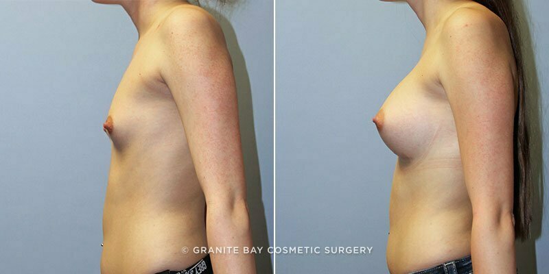 breast-augmentation-9652c-clark