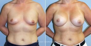 breast-augmentation-9666a-clark