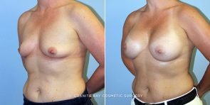 breast-augmentation-9666b-clark