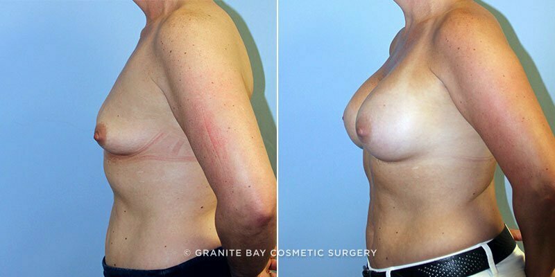 breast-augmentation-9666c-clark