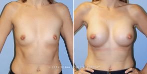 breast-augmentation-9691a-clark