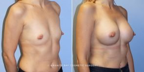 breast-augmentation-9691b-clark