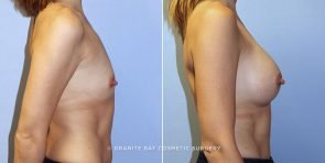 breast-augmentation-9691c-clark