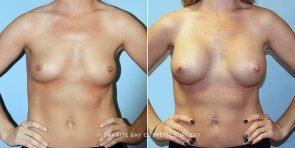 breast-augmentation-9728a-clark