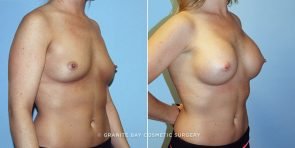 breast-augmentation-9728b-clark