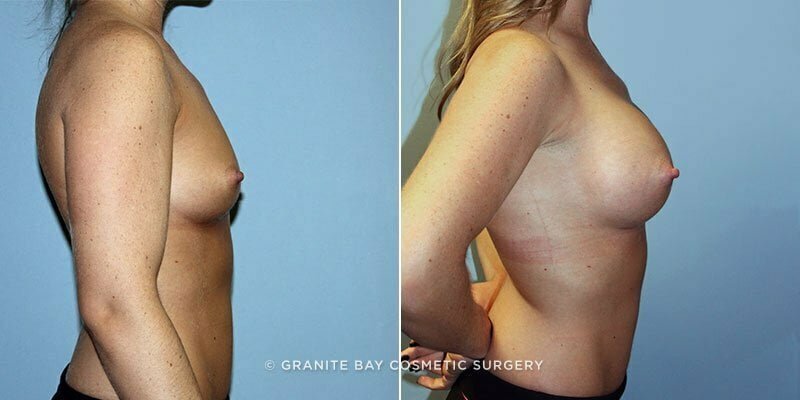 breast-augmentation-9728c-clark