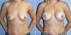 breast-augmentation-9778a-clark