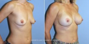 breast-augmentation-9778b-clark