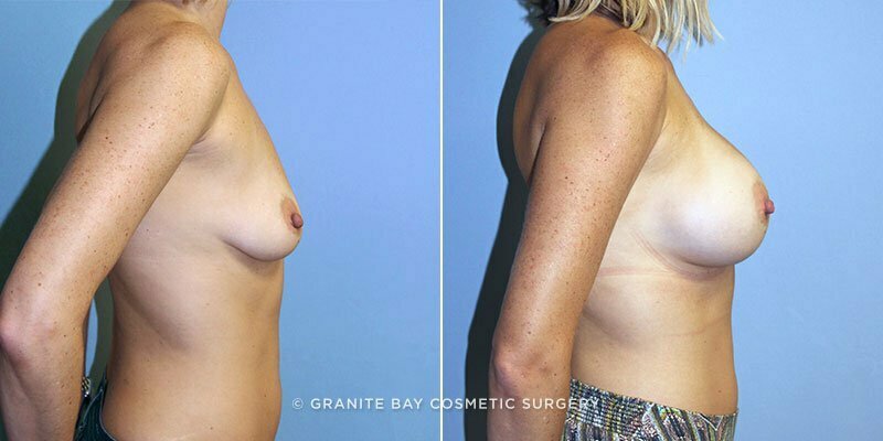 breast-augmentation-9778c-clark