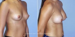 breast-augmentation-9844b-clark
