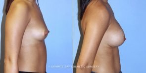 breast-augmentation-9844c-clark