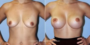breast-augmentation-with-lift-9154a-clark
