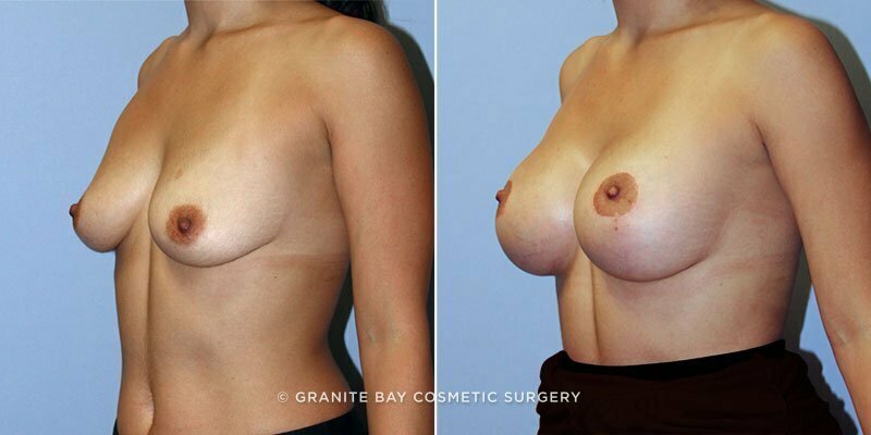 breast-augmentation-with-lift-9154b-clark