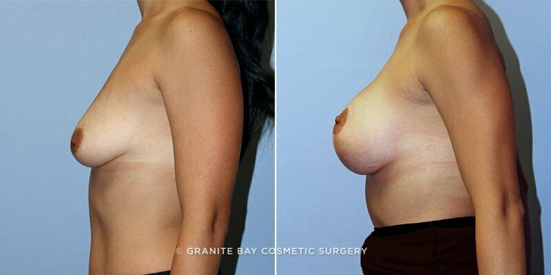 breast-augmentation-with-lift-9154c-clark