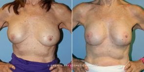 breast-implant-revision-9305a-clark